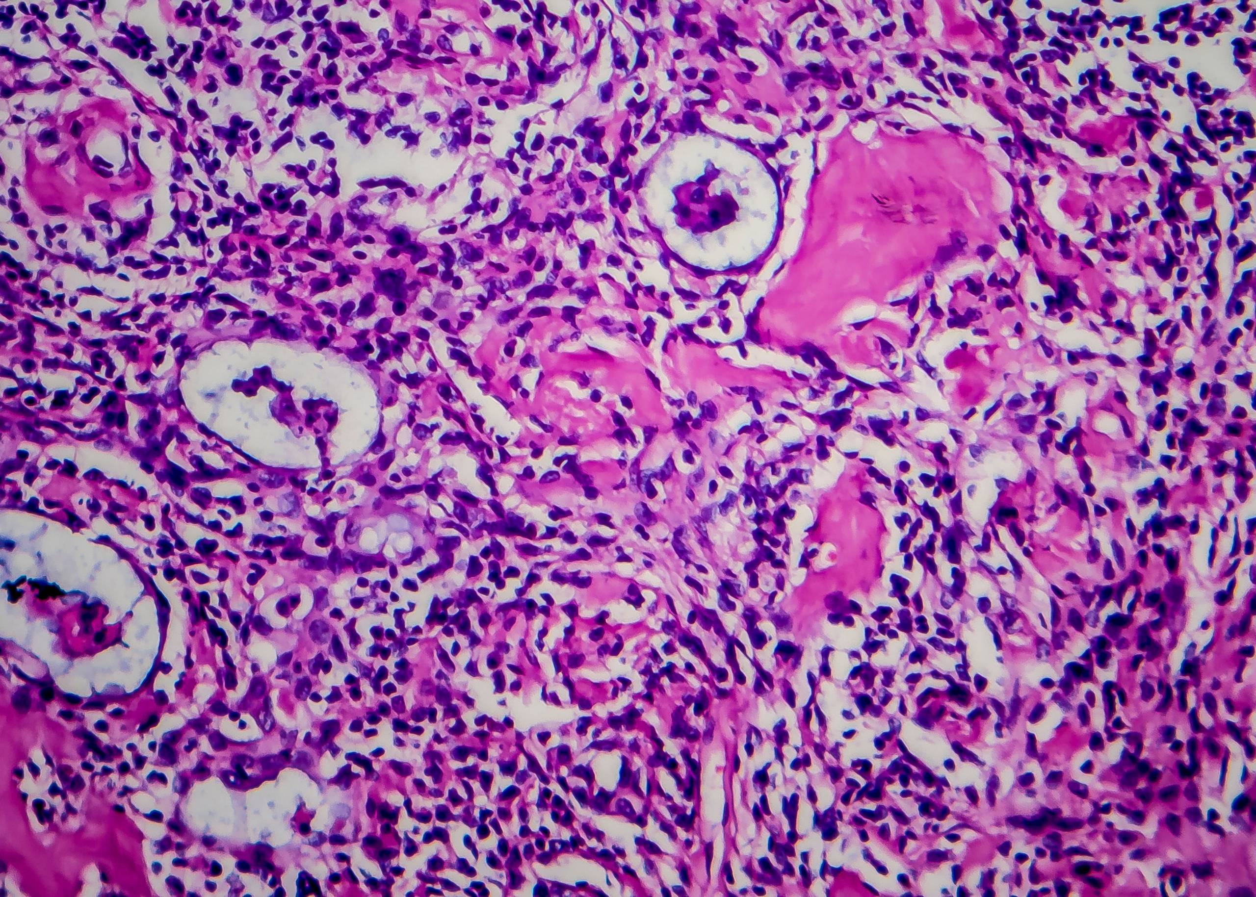 Hodgkin Lymphoma – Symptoms, Causes & Treatment