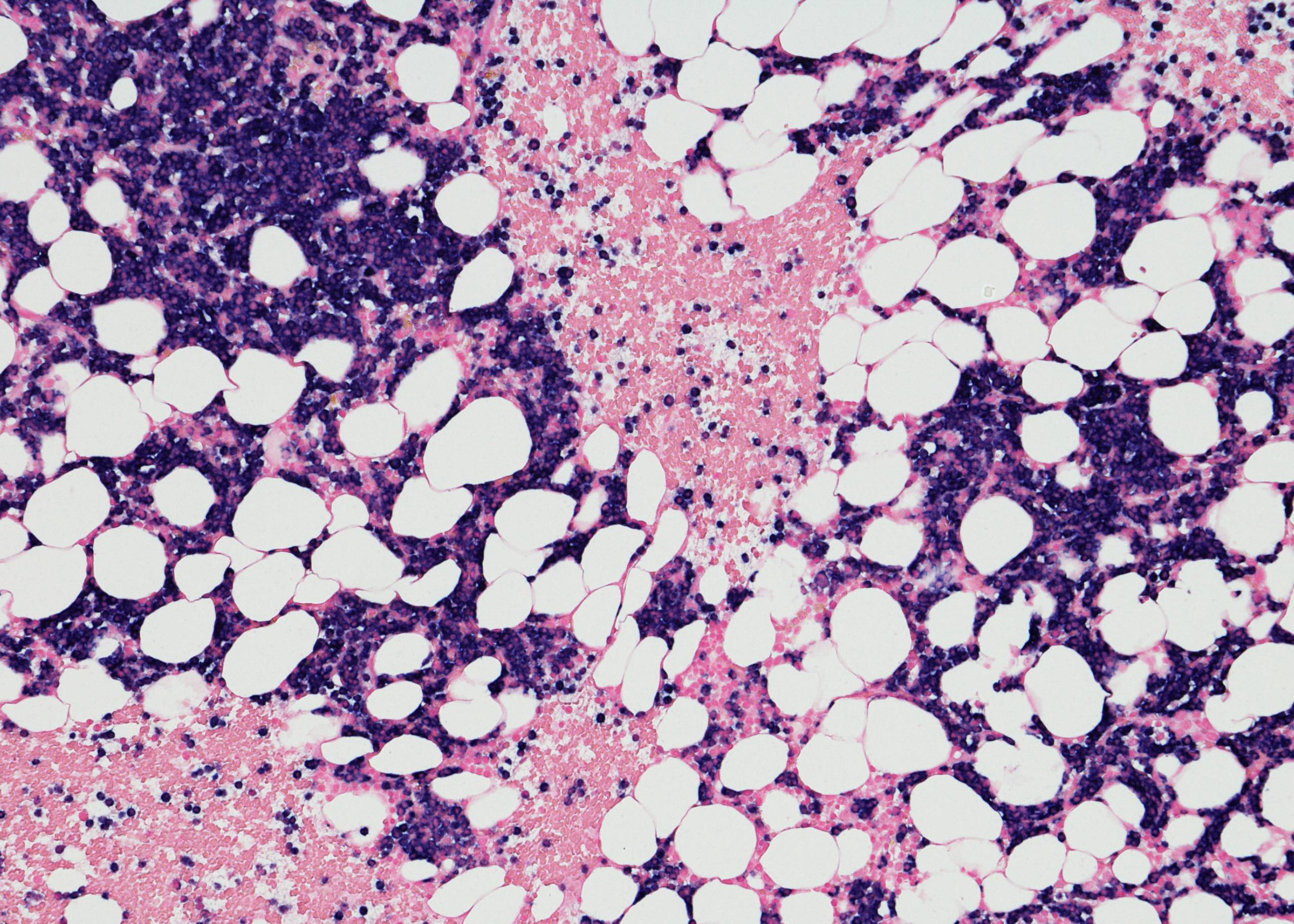 Multiple Myeloma – Symptoms, Causes & Treatment