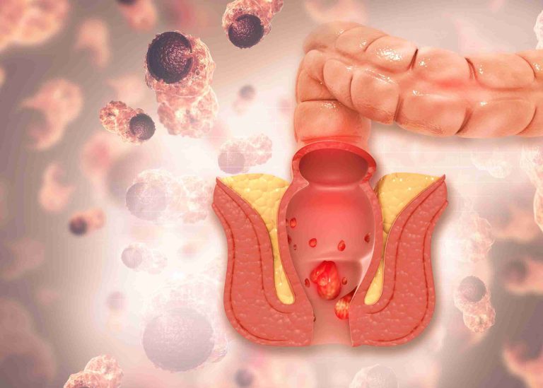 Hemorrhoids – Symptoms, Causes & Treatment