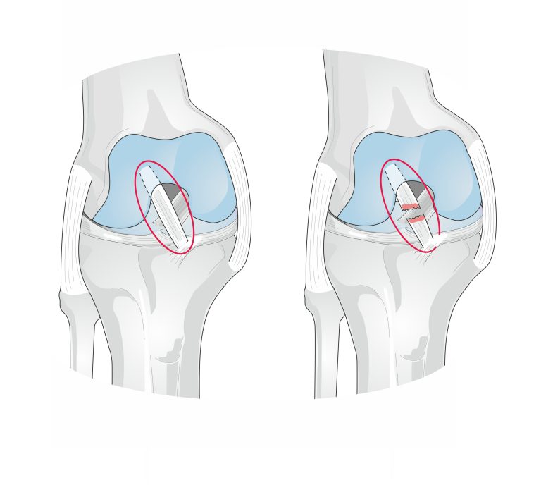 Anterior Cruciate Ligament (ACL) Injury