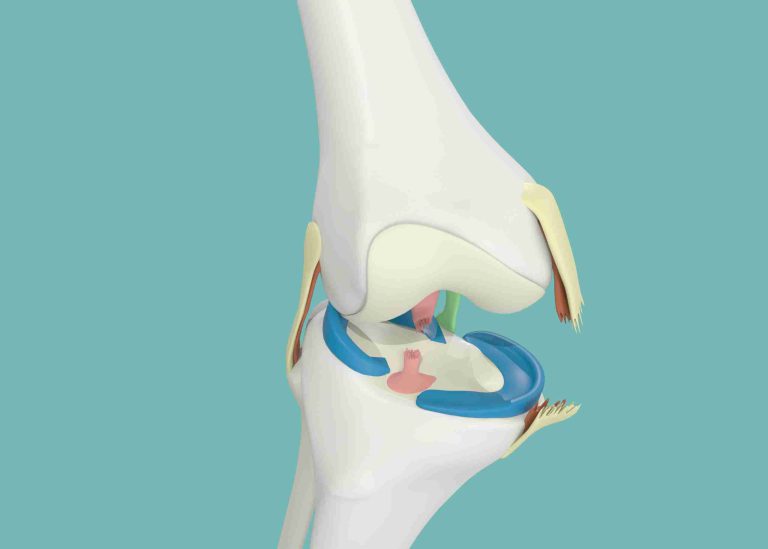 Medial Collateral Ligament (MCL) Injury