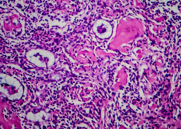 Hodgkin Lymphoma – Symptoms, Causes & Treatment