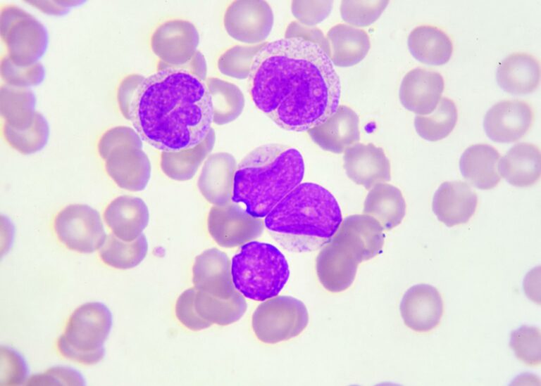 Leukemia – Symptoms, Causes, Diagnosis & Treatment