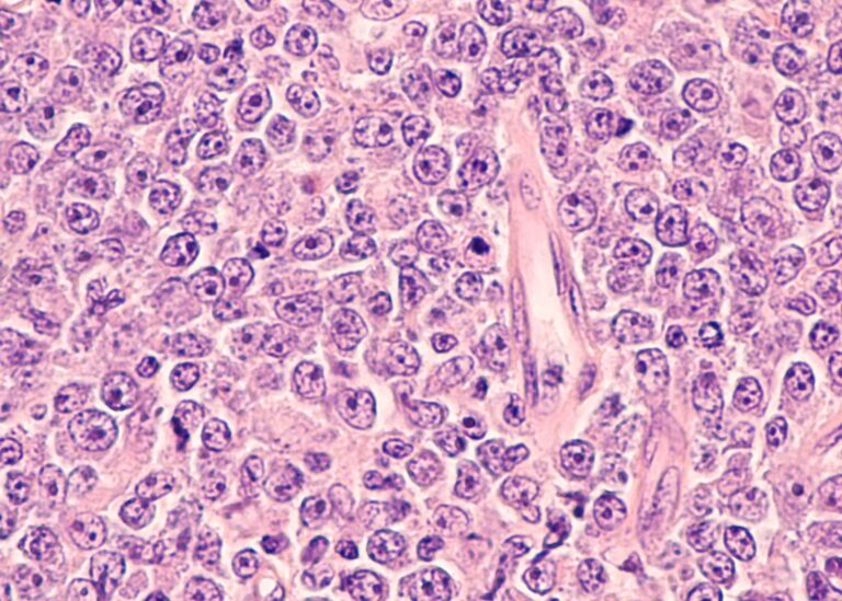 Lymphoma – Symptoms, Causes & Treatment