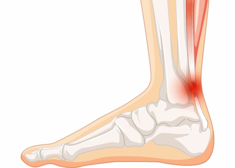Achilles Tears Treatment by Dr. Roger Haene at Burjeel Hospital Abu Dhabi