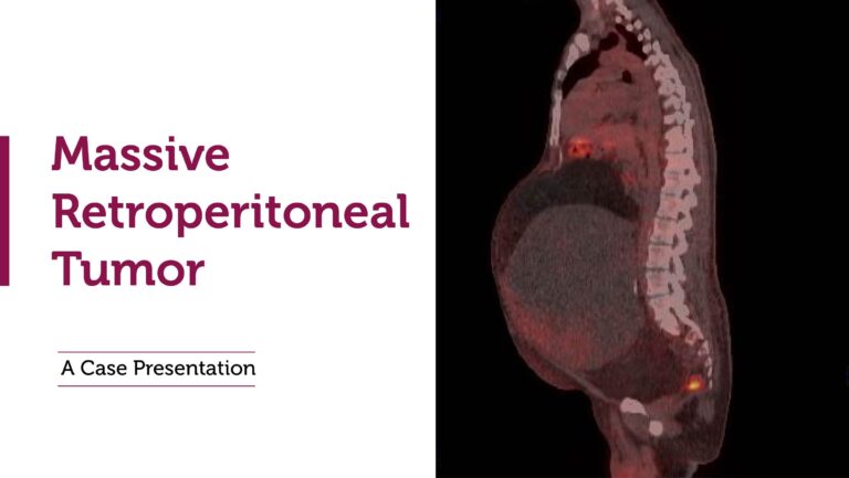 A Complex Case: Surgical Management of a Massive Retroperitoneal Tumor 