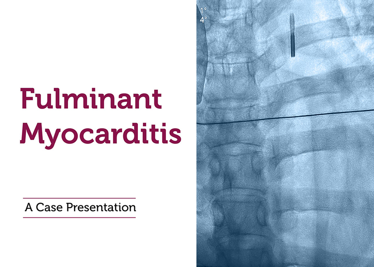 Fulminant Myocarditis