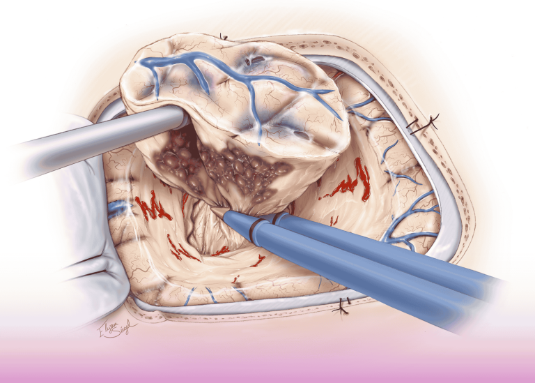 Advanced Neurosurgical Treatment: Minimally Invasive Management of Cavernous Vascular Malformations