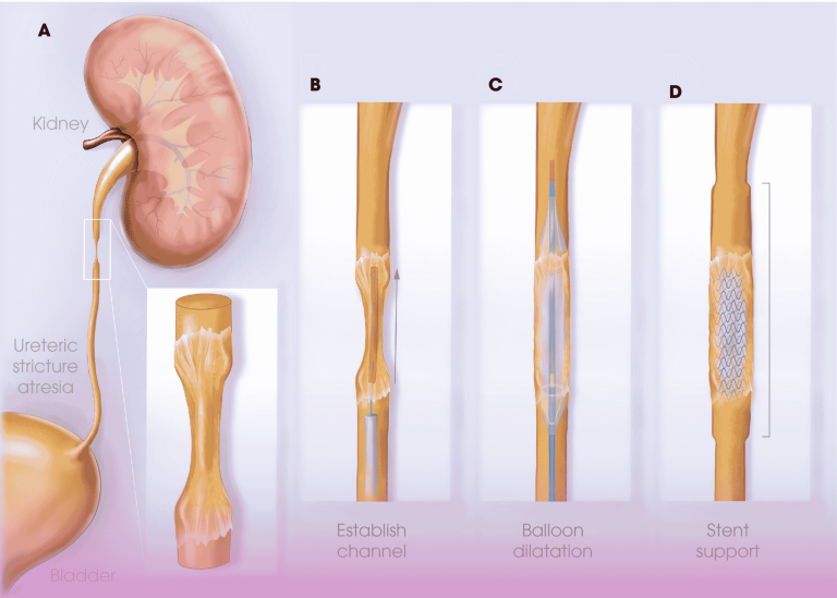 Pioneering Approach: Combined Laparoscopic and Ureteroscopic Management of Recurrent Ureteric Stricture