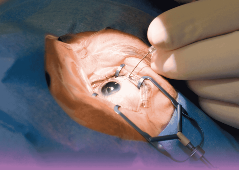 جراحة عين طارئة: إزالة جسم معدني غريب كبير من التجويف الحجاجي