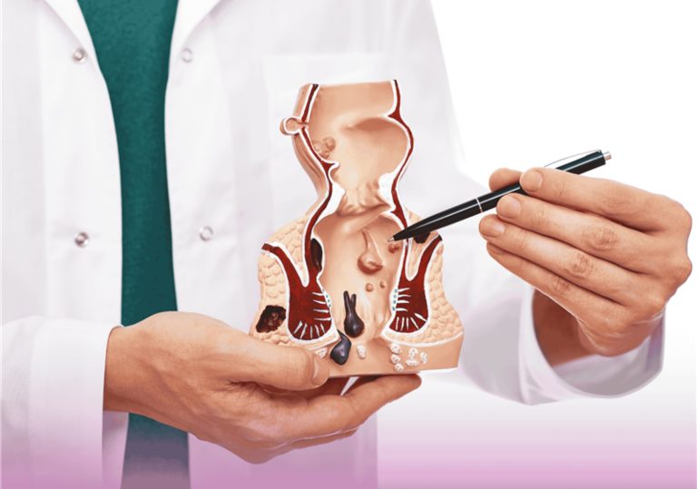 البواسير: دليل شامل للأعراض والعلاج وتخفيف البواسير الخارجية