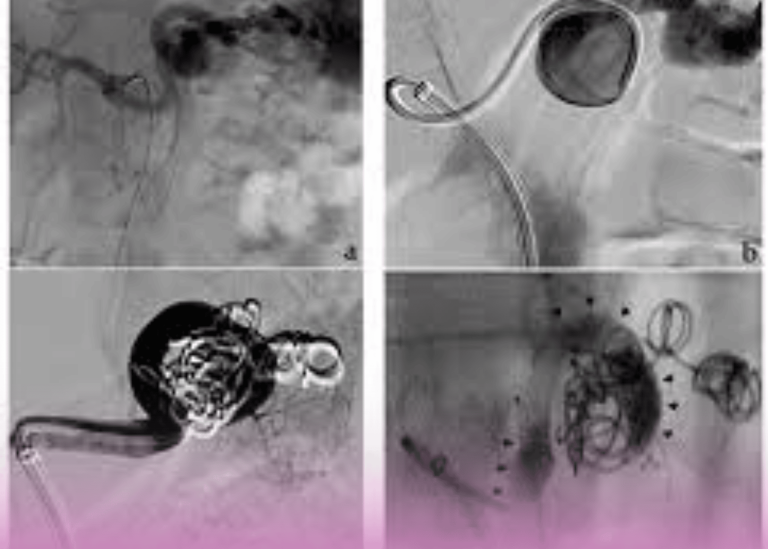 Innovative Coil-and-Glue Technique for Hepatic Artery Aneurysm: A Minimally Invasive Life-Saving Solution