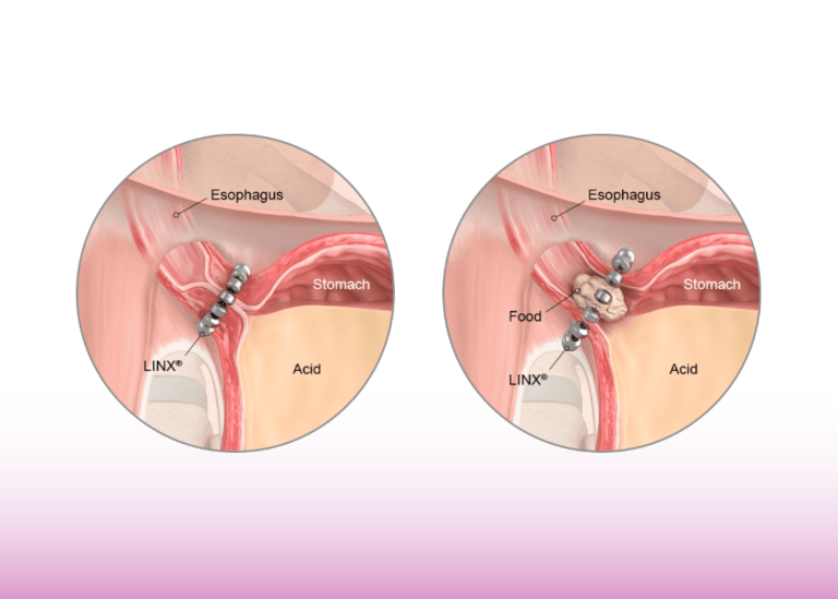 LINX Device Successfully Treats Severe GERD in Post-Bariatric Surgery Patient: A Day-Case Procedure