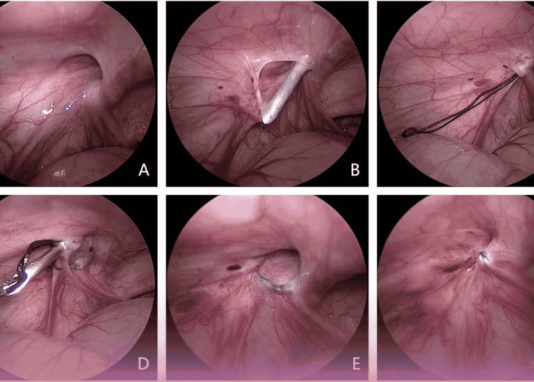 Minimally Invasive Surgery Advances: Laparoscopic Hernia Repair in Neonates