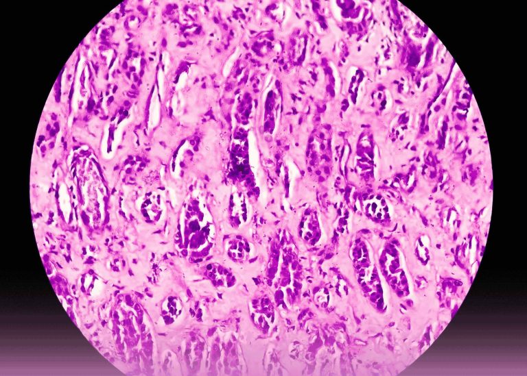 Open Radical Nephrectomy for Large Renal Cell Carcinoma