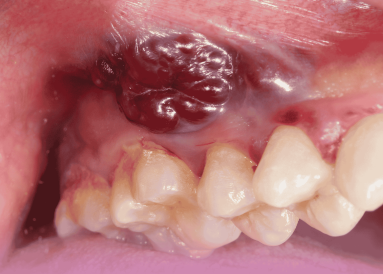 سرطان تجويف الفم المتقدم: التدبير الجراحي المعقد مع إعادة البناء باستخدام الشريحة الشظوية الحرة المجهرية الوعائية
