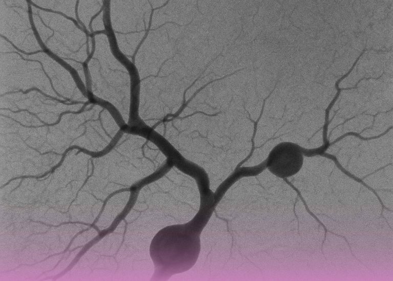 حالة طارئة وعائية نادرة تمت معالجتها بنجاح بواسطة الجراحة الوعائية المتقدمة