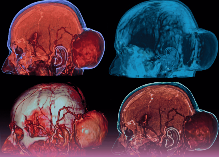 كوردوما قاع الجمجمة مع ضغط على جذع الدماغ: التنقل في تحدٍ جراحي عصبي معقد