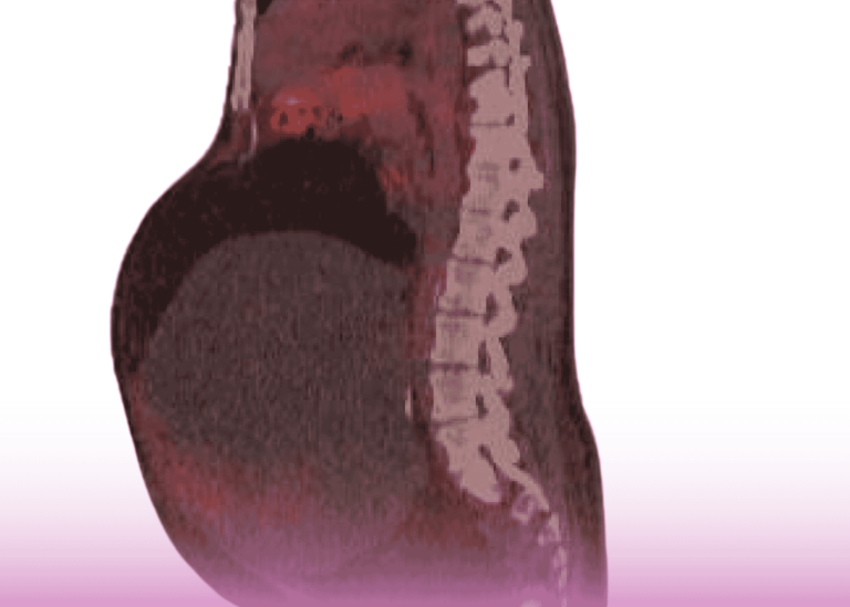 Surgical Giants: Successful Removal of Massive 16.2 kg Retroperitoneal Tumor at Burjeel Hospital