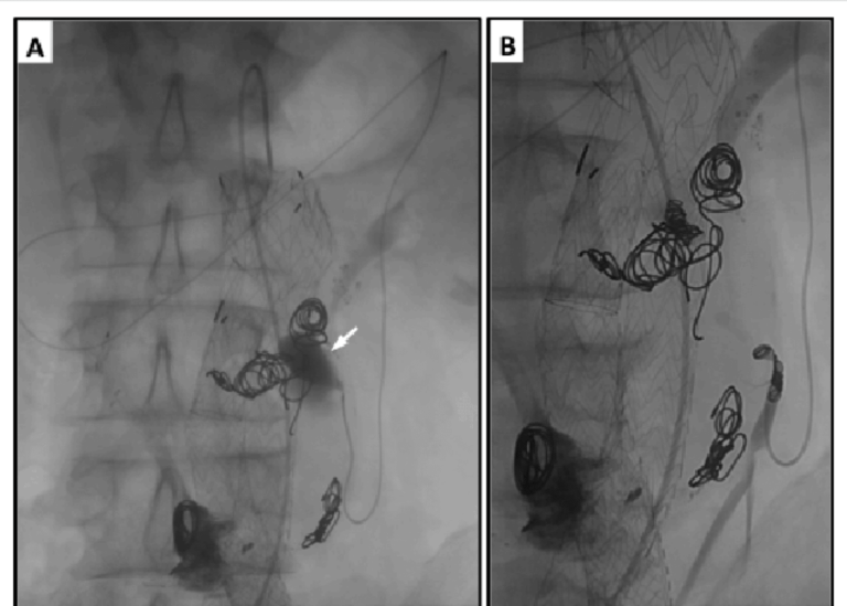 Life-Saving Intervention: Transcatheter Coil Embolization of Inferior Mesenteric Artery Pseudoaneurysm