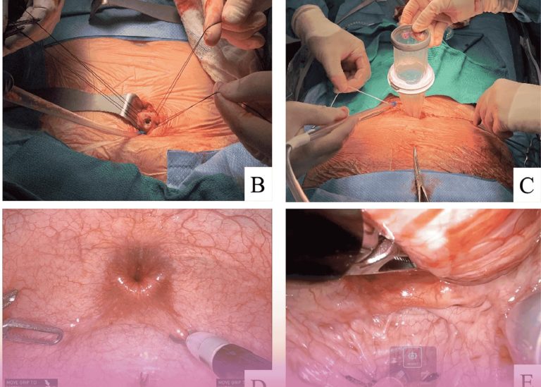 Open Transvesical Prostatectomy for Massive Prostatic Hyperplasia