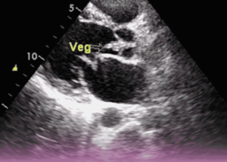 Septic Shock and Infective Endocarditis: A Landmark Cardiac Surgery Case Study